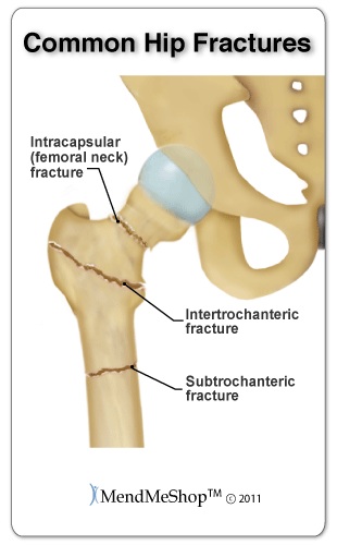 Hip fractures can occur in the femoral head or further down the femur below the intertrochanteric line.