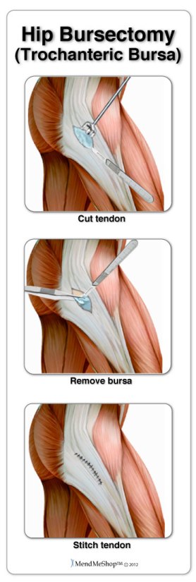 Many hip conditions are treated with arthroscopic surgery; bursitis, tendinitis, iliopsoas tendon tear, labral tear repair, cartilage trimming, snapping hip syndrome, and trimming bone spurs.