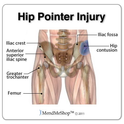 Hip pointer injuries are usually a result of a direct blow causing a contusion on the outer hip.