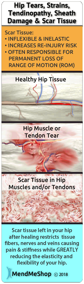Hip surgery can heal with difficulties because of scar tissue