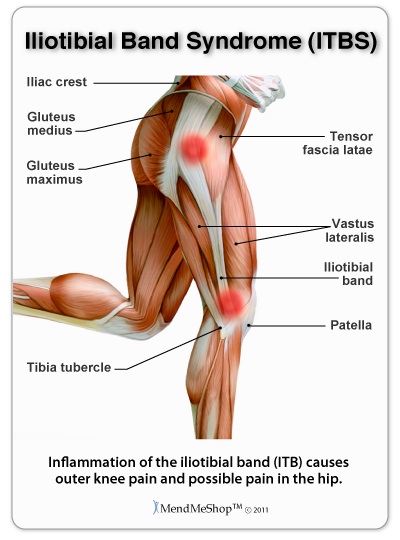 Iliotibial band syndrome causes pain near the knee and side of the hip.