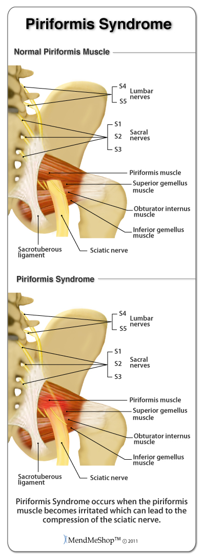 Piriformis Syndrome is inflammation in the piriformis muscle which causes irritation and compression of the sciatic nerve.