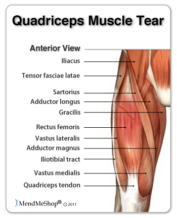 Quad muscle tear
